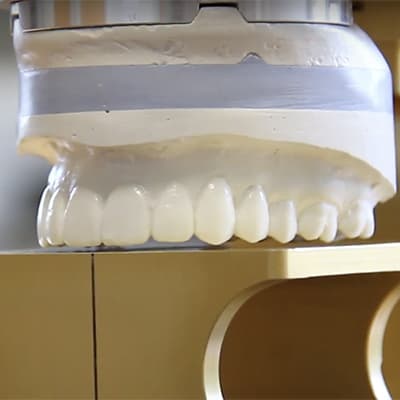 Model of a tooth to show off how Pinhole Surgical Technique works